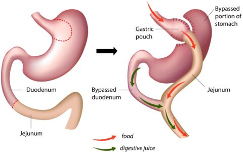 gastric-bypass