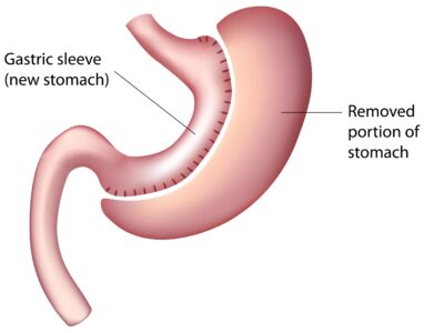 gastric-sleeve